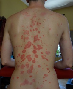 Spots on my back
